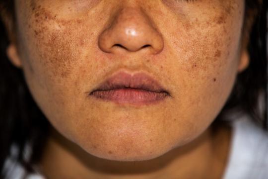 Melasma ontraadseld: Alles wat je moet weten over Melasma en hoe je het onder controle kunt houden